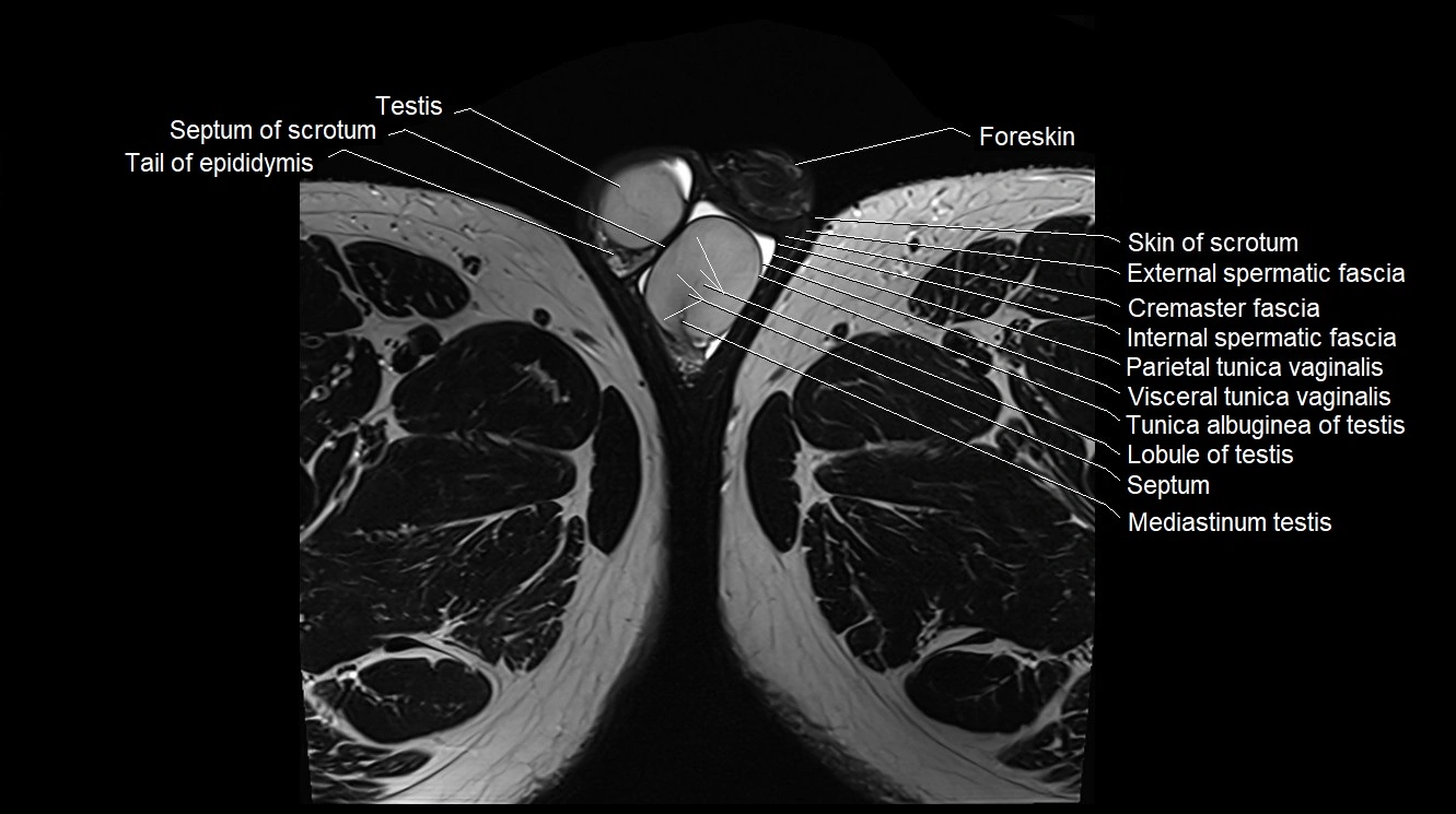 MRI 3T scrotum and penis axial cross sectional anatomy image 36.webp
